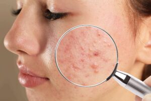 25. ACNE CARE TREATMENT: Your Comprehensive Guide to Clear Skin